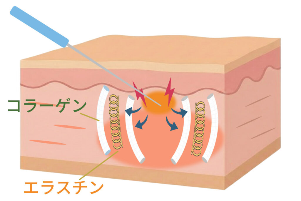 コラーゲンとエラスチン